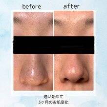 ～お客様のお肌変化～究極のアンチエイジング